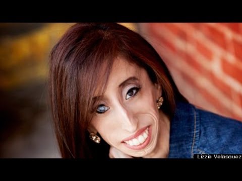 WATCH VIDEO: “Ugliest” Woman In The World — Lizzie Velasquez