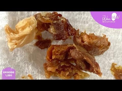 1,350 - Client with Painful Grade II Keratosis Obturans Successfully Treated