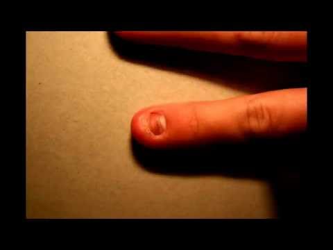 Time Lapse of fingernail growing back