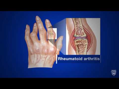 Mayo Clinic Minute What’s rheumatoid arthritis?
