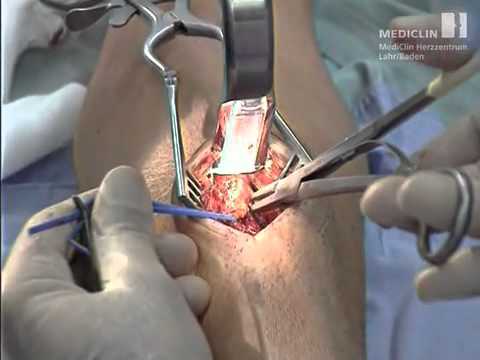 Prélèvement de l'artère radiale - technique mini-invasive