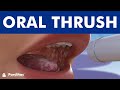 ORAL THRUSH - Candidiasis or yeast infection. Angular cheilitis ©