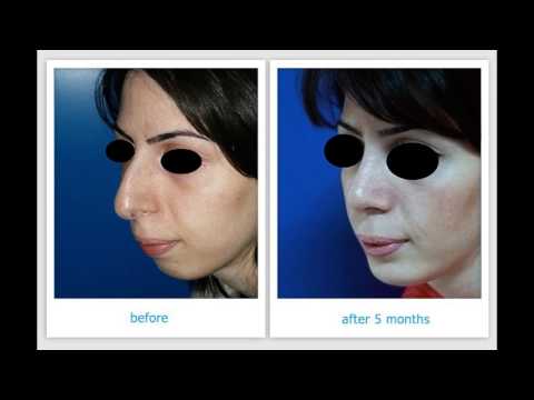 Քթի պլաստիկա (ռինոպլաստիկա) / Աշոտ Լյուդվիգովիչ