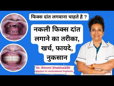 How to get fixed teeth, cost, and benefits | What is the cost of getting new teeth? Dental Implan...