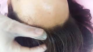 Scalp Hairline Density Restoration Microblading Micropigmentation by El Truchan @ Perfect Definition