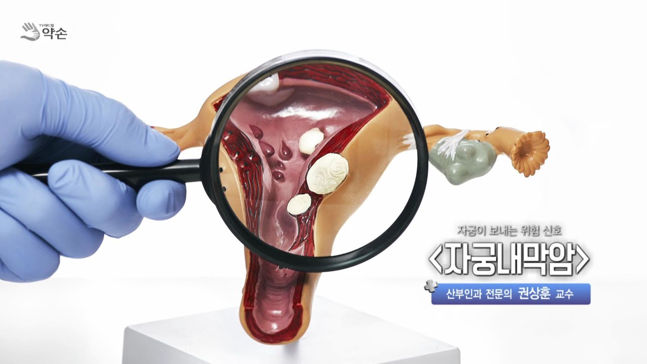 [TV메디컬약손]755회 자궁이 보내는 위험 신호 '자궁내막암'(20241112 방송)