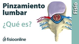 Pinzamiento lumbar - ¿Qué es