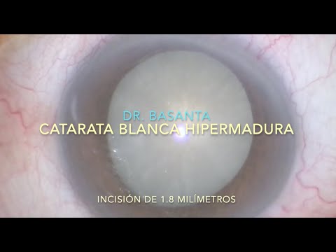 Catarata Blanca Hipermadura