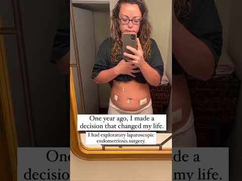 Endometriosis Excision Surgery: The best decision I made