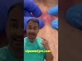 Infected abscess to skin. Dr Khaled Sadek LipomaCyst.com