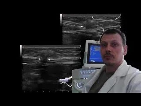 Pediatric Soft tissue ultrasound - Hernia of the linea alba vs lipoma