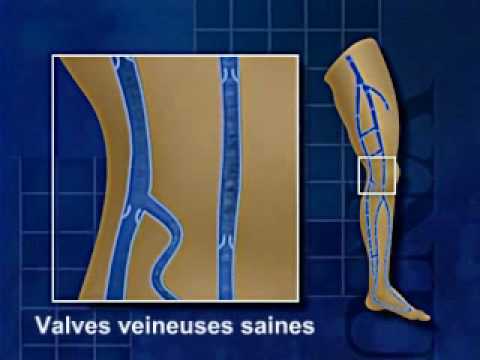 Vidéo sur le reflux veineux