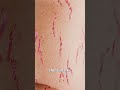 How Stretch Marks Appear