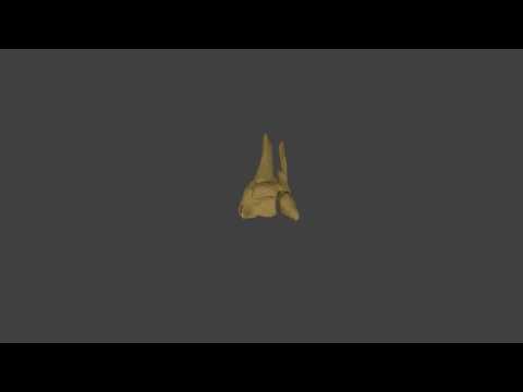 Malunited tibia and fibula 3D reconstruction 360 video