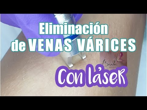 Eliminacion Venas Varices con láser