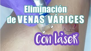 Eliminacion Venas Varices con láser