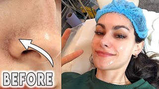 Getting the Red Veins around my Nose Lasered! | Alya Amsden