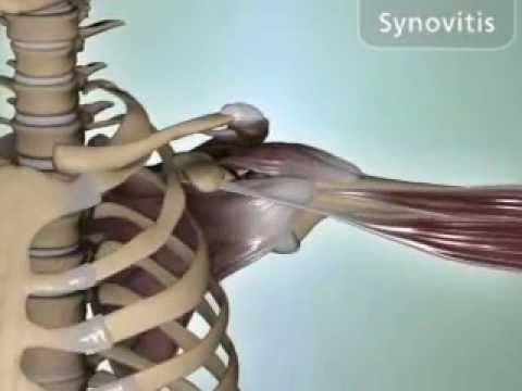 Synovitis és bursitis a vállízület kezelésében Bursitis (nyáktömlő gyulladás)