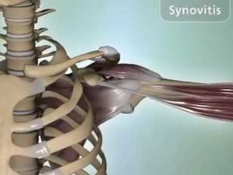 2. fokozatú osteoarthritis vállkezelés