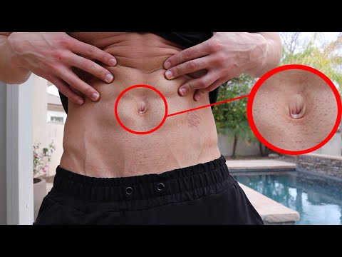 Umbilical Hernia NO SURGERY NEEDED!