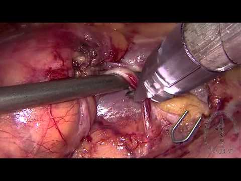 Laparoscopic Radical Nephrectomy - Ureteral Mobilization