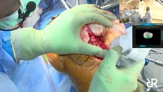 Dr. Stefan Kreuzer performs Total Knee Arthroplasty using the Think Surgical Robot | TCAT.