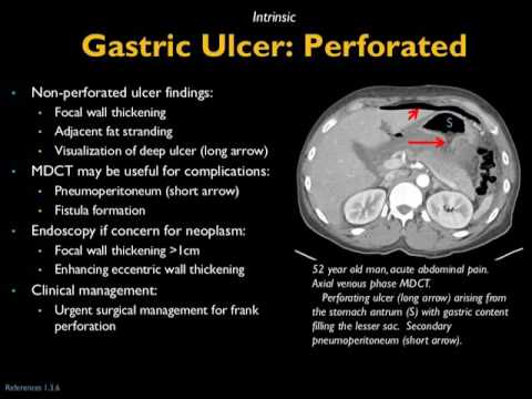 Was it something I ate? Gastric causes of acute abdominal pain on MDCT (non-malignant)