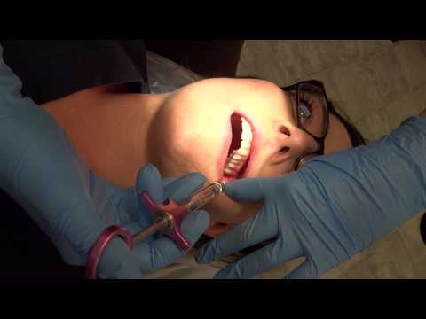 How to give a Posterior Superior Alveolar (PSA) Injection (PART 1)