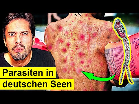 Parasit bohrt sich in deine Blutbahn! Gefahr am See?