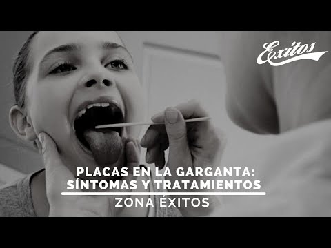 EN VIVO Zona Éxitos 02.06.2021 Placas en la garganta con el Dr Luciano Saglimbeni