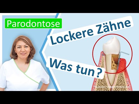Parodontitis: Was kann man tun, wenn Zähne schon locker sind?  Zahnarztpraxis N. Redjai Großostheim