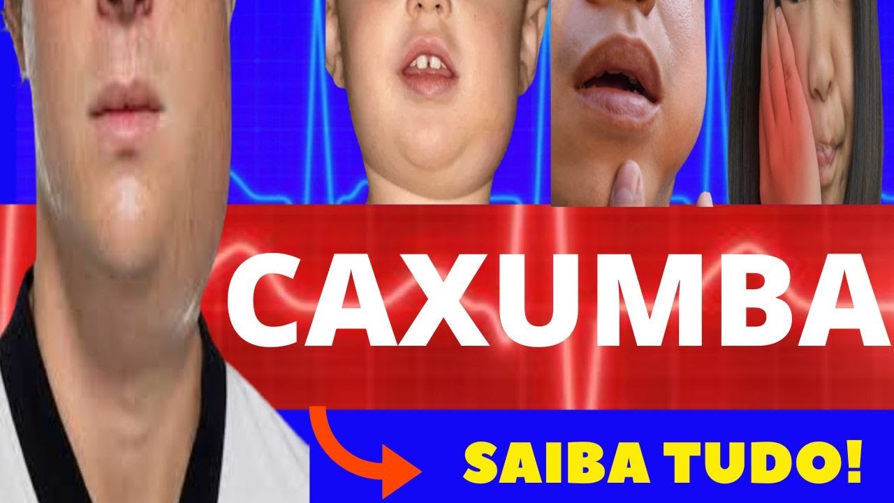CAXUMBA - O QUE É, SINTOMAS, DIAGNÓSTICO E TRATAMENTO - TUDO SOBRE CAXUMBA