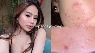 HOW I CLEARED MY SKIN | my acne journey, skincare, tips.