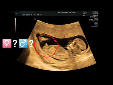 How is fetal gender determined on ultrasound. 14th week in the womb. Guess: Is it a boy or a girl?