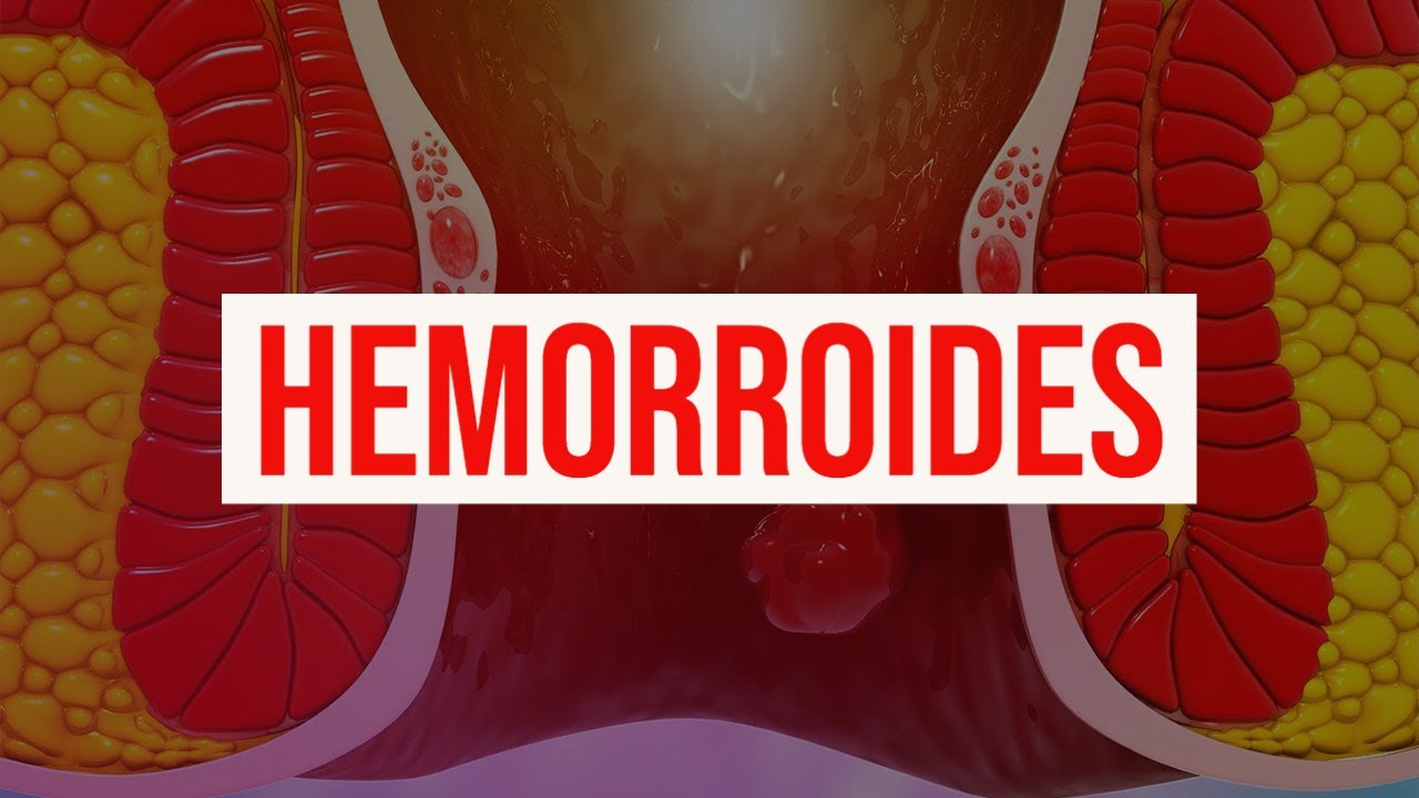 Hemorrhoids: causes, diagnosis, symptoms, treatment and prevention (piles and rectal bleeding)