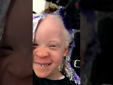Unbelievable Transformation of Albino Girl 💖 #shorts