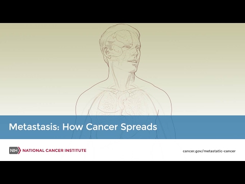 Metastasis: How Cancer Spreads