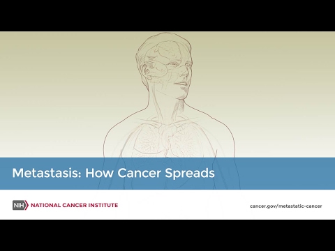 metastasis: how cancer spreads