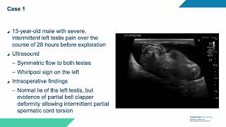 Core Videos (2025): Whirlpool Sign Ultrasound Findings in Testicular Torsion