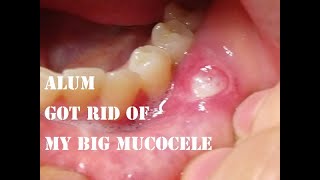 Alum Got Rid of My Big Mucocele