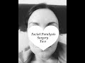 Facial Paralysis Surgery Part 2