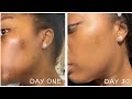HOW I GOT CLEARER SKIN IN A MONTH 30 DAY RESULTS