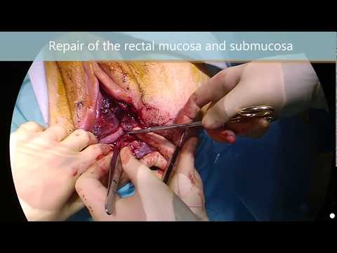 Emergent repair of a fourth degree perineal tear
