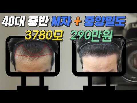 M字毛发移植发际线密度增强 毛发移植费用 3780毛 290万韩元 包含根独有的MAX4000程序管理程序