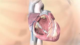 Dr. Nghia Hoang & World's Smallest Pacemaker