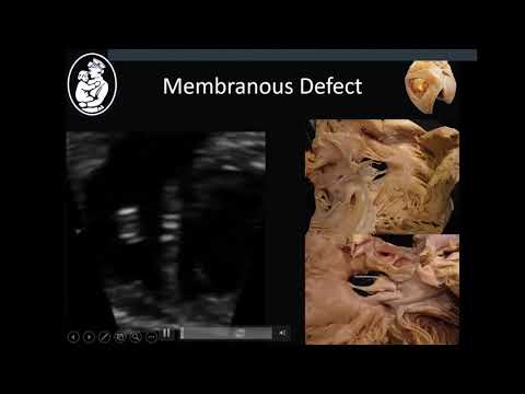 Ventricular septal defects - Stephen Sanders, MD