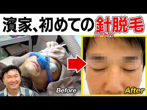 【針脱毛】かまいたち濱家が初めての針を使ったニードル脱毛体験！