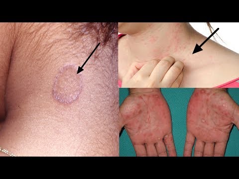 Matar a la disputa del hongo de las uñas El hongo de la uña el tratamiento klotrimazolom