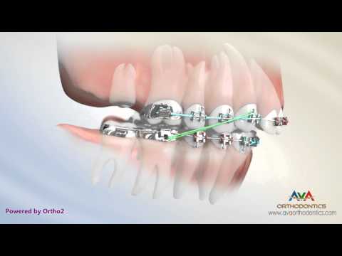 Orthodontic Treatment for Overbite (Overjet) - Removing Second Molar