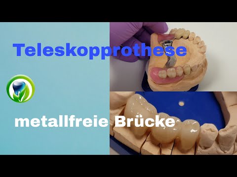 Patientenfall Behandlungsablauf - Oberkiefer Teleskopprothese | Unterkiefer Brücke